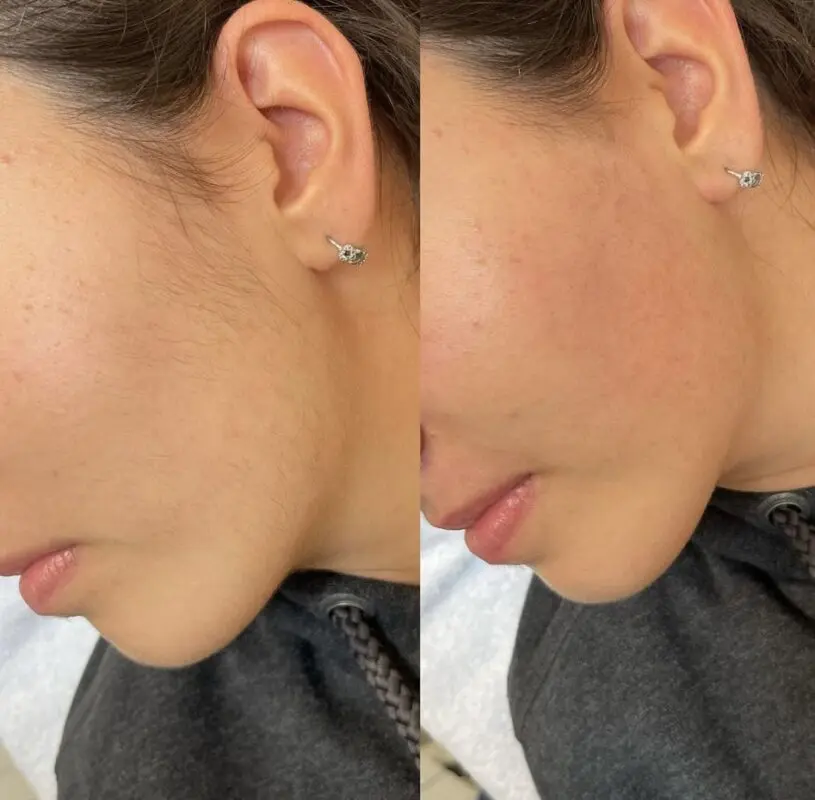 Vorher-Nachher-Ergebnis einer 3 W Dioden Ice-Laser-Behandlung zur Entfernung von Gesichtshaaren bei Mel’s Beauty & Academy in 5212 Hausen AG.