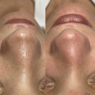 Vorher-Nachher-Ergebnis einer Beautymaster-Behandlung zur Verfeinerung der Poren bei Mel’s Beauty & Academy in 5212 Hausen AG.