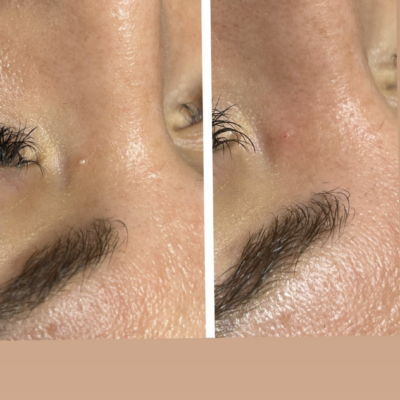 Vorher-Nachher-Ergebnis einer Milien-Entfernungsbehandlung bei Mel’s Beauty & Academy in 5212 Hausen AG.