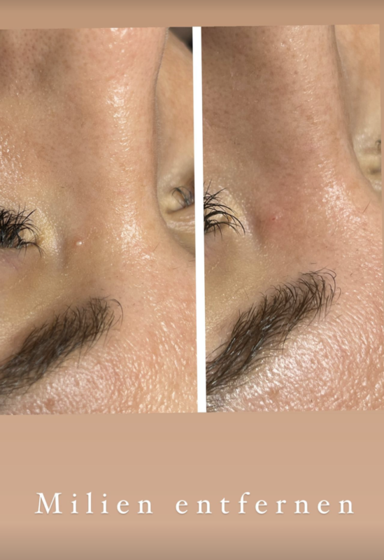 Vorher-Nachher-Ergebnis einer Milien-Entfernungsbehandlung bei Mel’s Beauty & Academy in 5212 Hausen AG.
