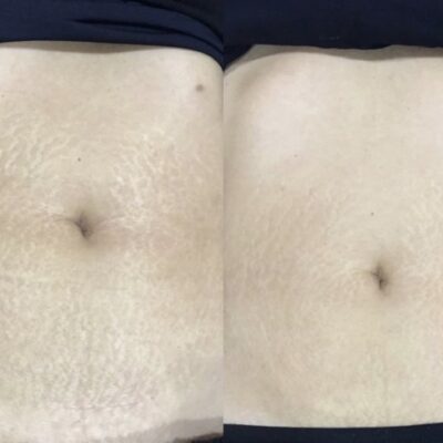 Vorher-Nachher-Ergebnis einer Fibroderms XS-Behandlung zur Reduktion von Dehnungsstreifen bei Mel’s Beauty & Academy in 5212 Hausen AG.
