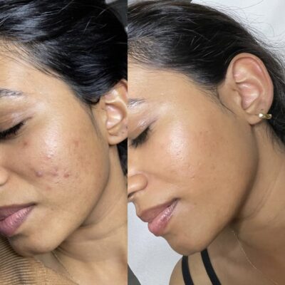 Vorher-Nachher-Ergebnis einer Microneedling-Behandlung zur Verbesserung der Hautstruktur und Akne-Reduktion bei Mel’s Beauty & Academy in 5212 Hausen AG.