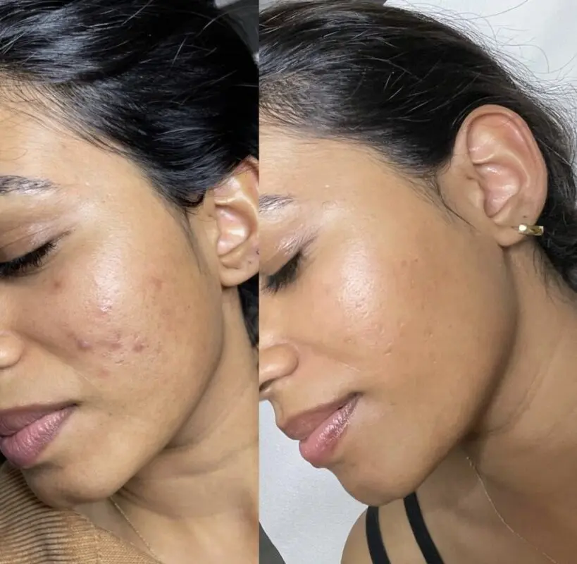 Vorher-Nachher-Ergebnis einer Microneedling-Behandlung zur Verbesserung der Hautstruktur und Akne-Reduktion bei Mel’s Beauty & Academy in 5212 Hausen AG.