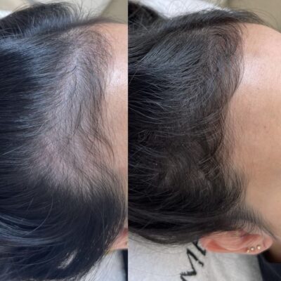 Vorher-Nachher-Ergebnis einer Mesohair-Behandlung zur Förderung des Haarwachstums bei Mel’s Beauty & Academy in 5212 Hausen AG.