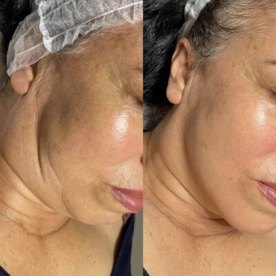Vorher-Nachher-Ergebnis einer Mesoéclat-Behandlung zur Reduktion von Falten und Hautverjüngung bei Mel’s Beauty & Academy in 5212 Hausen AG.