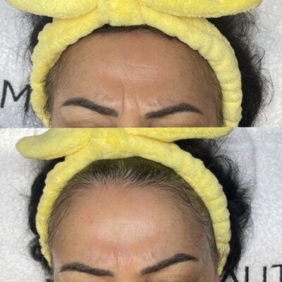 Vorher-Nachher-Ergebnis einer Skinbooster-Behandlung zur Reduktion von Stirnfalten und Hautglättung bei Mel’s Beauty & Academy.