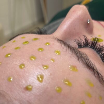 Nahaufnahme einer BioRePeelCl3 Behandlung auf der Stirn einer Kundin mit gelblichen Wirkstoff-Tropfen für eine glattere und regenerierte Haut.