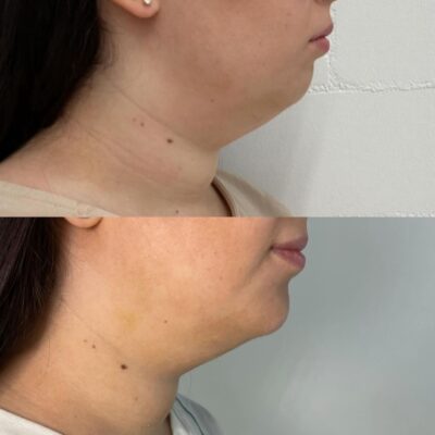 Vorher-Nachher-Ergebnis einer F & B Fettwegspritze-Behandlung bei Mel’s Beauty & Academy zur Reduktion von Fett im Kinn- und Halsbereich.