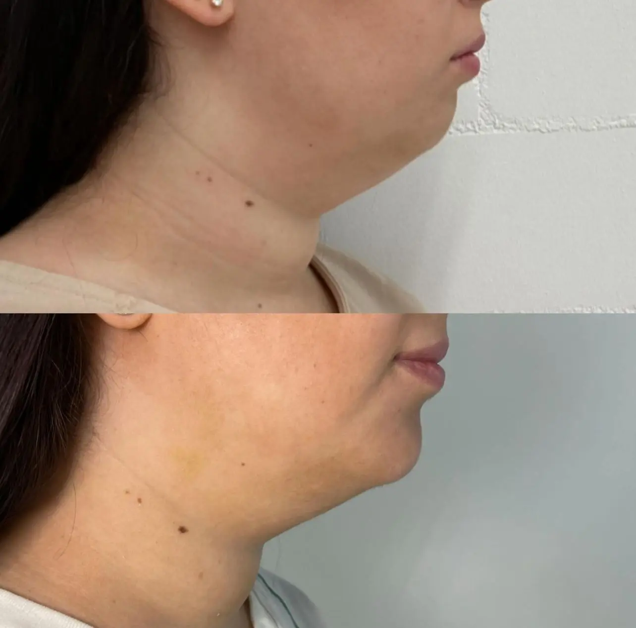 Vorher-Nachher-Ergebnis einer F & B Fettwegspritze-Behandlung bei Mel’s Beauty & Academy zur Reduktion von Fett im Kinn- und Halsbereich.