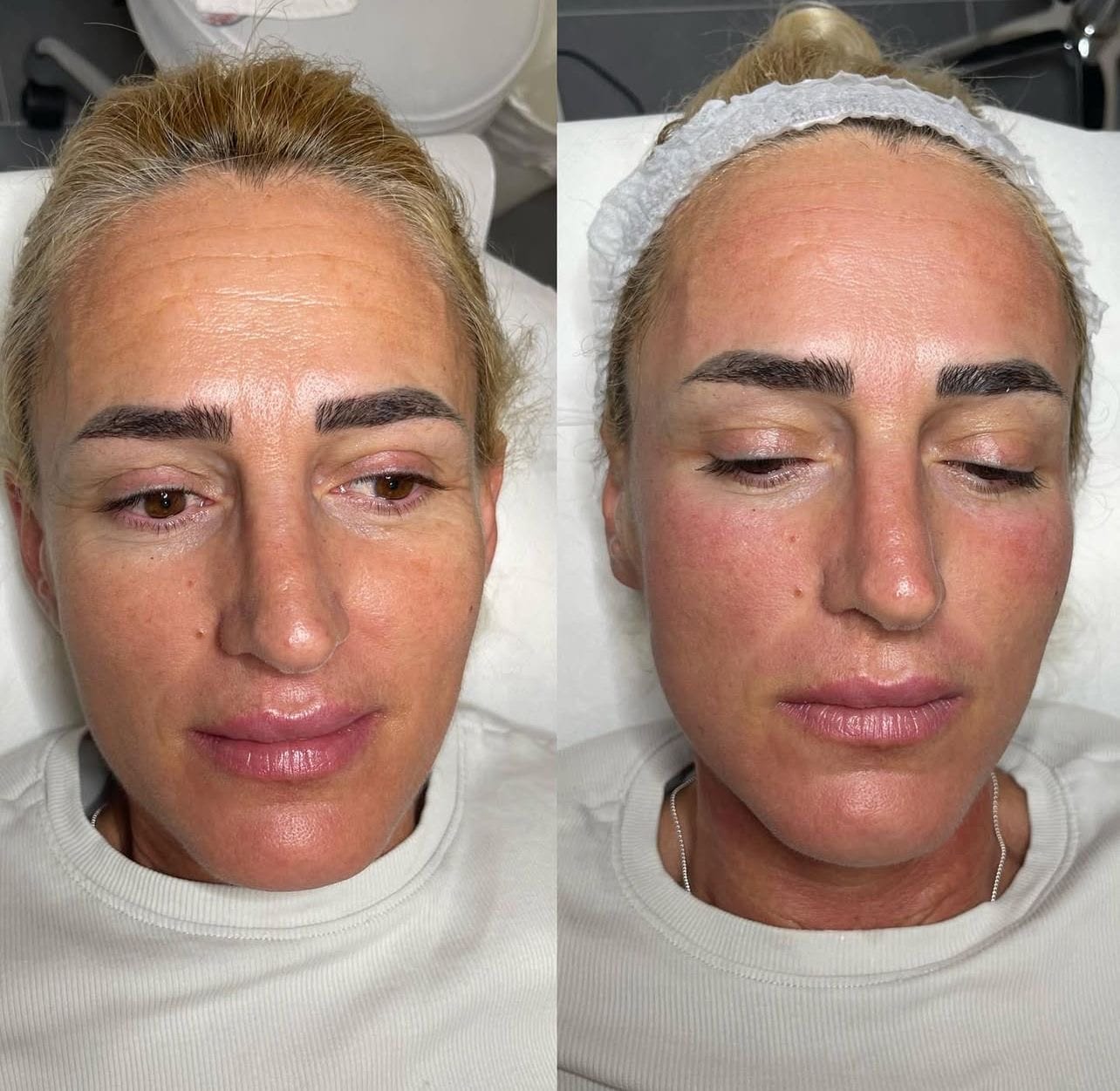 Microneedling Schulung bei Mel’s Beauty Academy