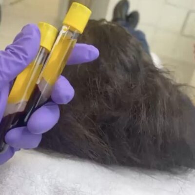 PRP Eigenblut Blutabnahme zur Vorbereitung einer regenerativen Haar- oder Hautbehandlung bei Mel’s Beauty & Academy in 5212 Hausen AG