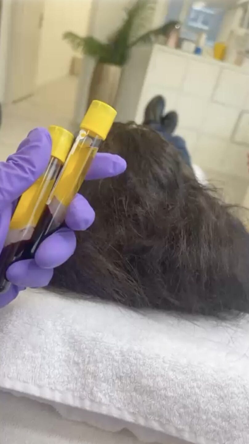 PRP Eigenblut Blutabnahme zur Vorbereitung einer regenerativen Haar- oder Hautbehandlung bei Mel’s Beauty & Academy in 5212 Hausen AG